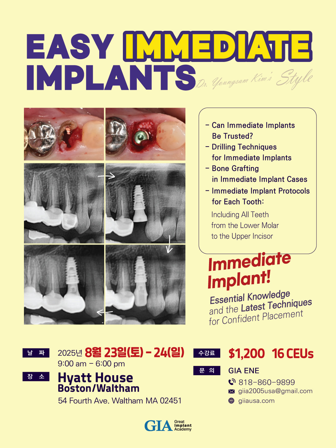 Boston) Easy Immediate Implant