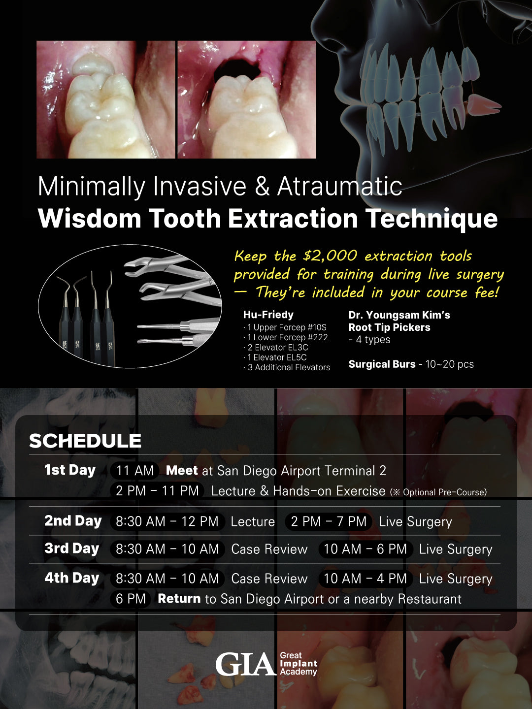 MEXICO LSC 2025 / October 9 - 12 [Third Molar Live Surgery Course]