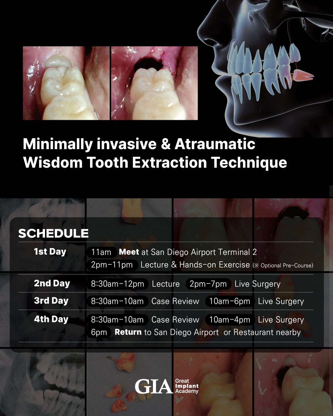 MEXICO LSC 2025 / May 23 - 26 [Third Molar Live Surgery Course]