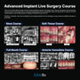 MEXICO LSC 2025 / January 23 - 27 [Implant Live Surgery Course]