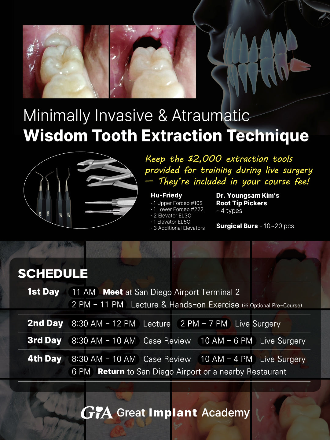 MEXICO LSC 2026 / February 5 - 8 [Third Molar Live Surgery Course]
