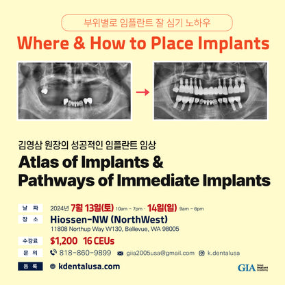 Seattle) Atlas of Implants & Pathways of Immediate Implants [24/7/13 ~ 7/14]