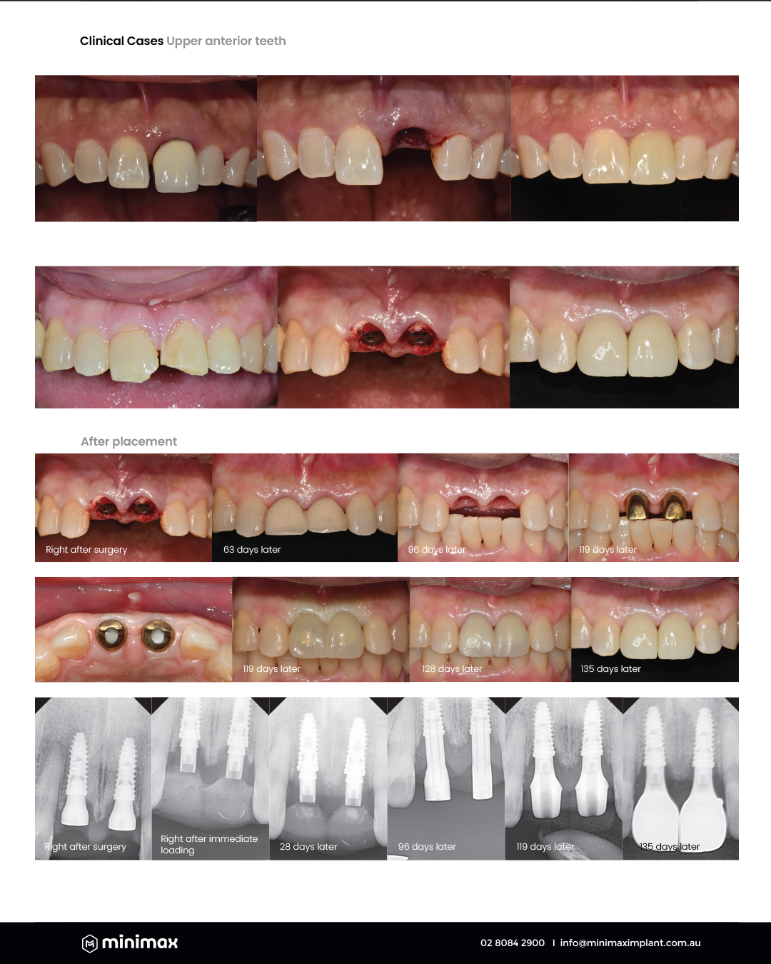 Sydney, Australia) Advanced Immediate Implant Course [2026/8/8 ~ 8/9]