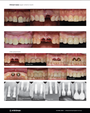 Sydney, Australia) Advanced Immediate Implant Course [2026/8/8 ~ 8/9]