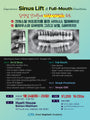 Boston) Comprehensive Sinus Lift & Full Mouth Rehabilitation