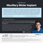 Los Angeles GIA Study Club) Maxillary Molar Implant