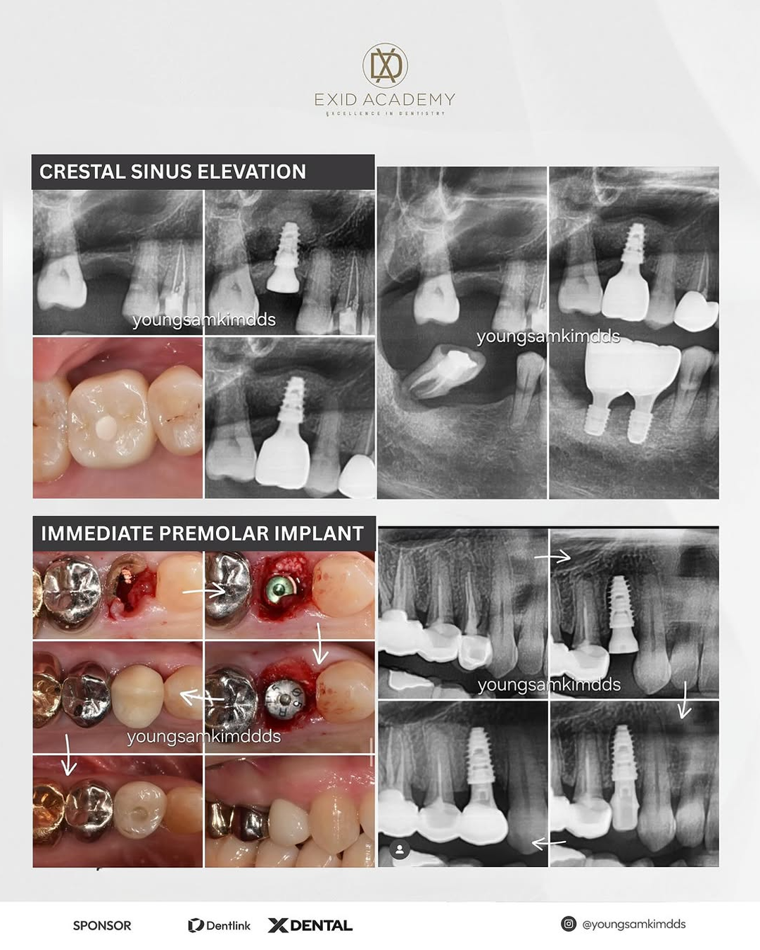 Sydney, Australia) Mastering Immediate Implants and Sinus Lift [2025/8/15 ~ 8/17]